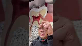 Understanding Toothache from a Cracked Tooth | In Office to Hands On Dental Training