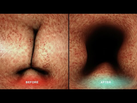 BPH 2 - prostate and urinary symptoms