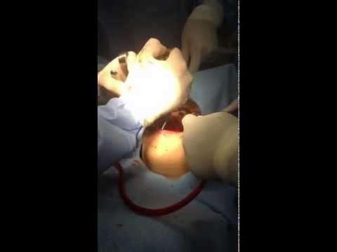 orthognathic surgery
