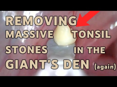 Removing several large tonsil stones | AIM 15