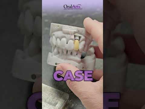 Single Anterior Tooth Restoration: Incredible Challenge! #dentalartistry