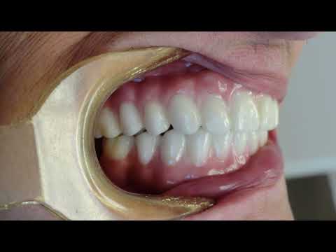 Elevator Pitch-Crown and Bridge Dept.-An Introduction to Utica Dental Lab's Crown & Bridge Dept