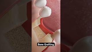 Bone Grafting (3D Animation)