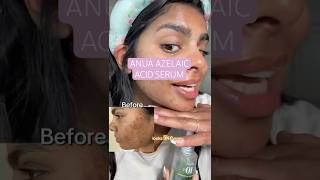Anua Azelaic Acid Serum for Dark Spots | Real Results Review