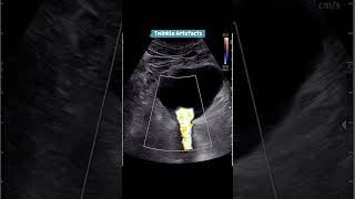 Twinkle Artefact #viralvideo #ultrasound #artifacts #twinkle #rdmseries #doctor