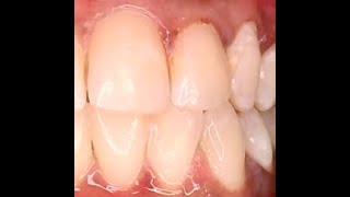 Class 3 LCR - Bioclear method