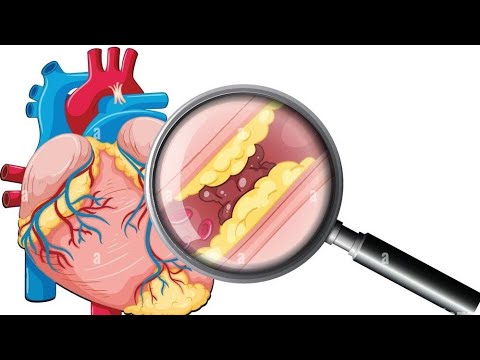 "Atherosclerosis Unveiled: Understanding Arterial Plaques"
