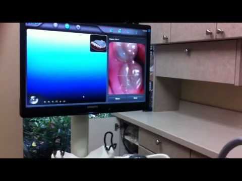 iTero: digital impression system at Dr. Nick Seddon's office