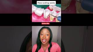 Deep cleaning at the dentist #shorts #teethcleaning #deepcleaning