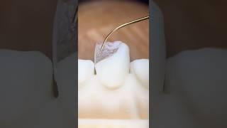 Free-hand technique anterior composite restoration #compositebonding #dental #doktergigi #dentist