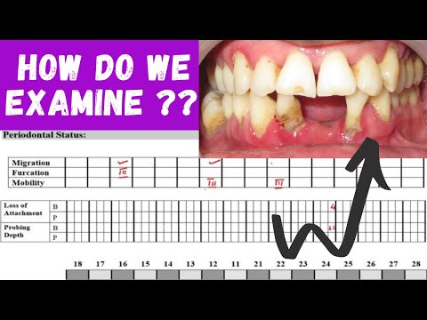 PERIODONTAL EXAMINATION ‖ HOW TO EXAMINE PERIODONTITIS PATIENT ?? ‖ PERIO HUB ‖ Dr  SNEHA