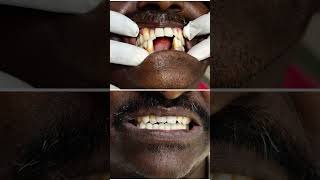 missingteeth#crownandbridge#replacement#fixedteeth#dentist#confidenceboost#dentaltreatment#smile.