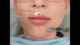 CAN A DEAD TOOTH BE REVIVED?LIKE , COMMENT AND SUBSCRIBE ;--)
