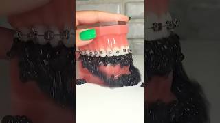 Why BROKEN Brackets Might Not Be Your Fault! 😎🦷