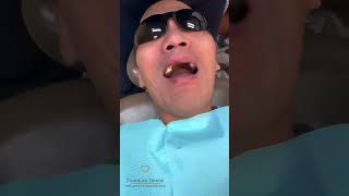 TITANIUM Dental - Front Implant Bridge  #dentist #dentalimplant #smile