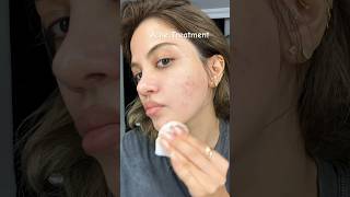 Acne Treatment routine so tired # #youtubechamps #acne #shorts #shortvideo #shortsviral