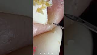 Skincare | Blackheads Removal #656 #tweezers skincare #blackheads blackheads