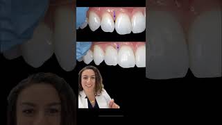 Cosmetic Dentistry: Bioclear Black Triangle Closure