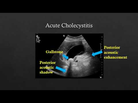 Abdominal US - Gallstones/Cholecystitis, Renal Stones/Hydronephrosis