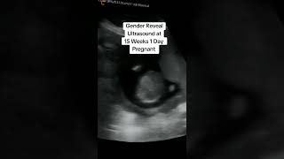 Gender Reveal Ultrasound at 15 Weeks 1 Day Pregnant #heybabymobile  #15weeks1daypregnant #babyscan