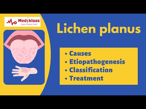 Lichen planus l Causes, symptoms, treatment l Oral pathology l Mediklaas
