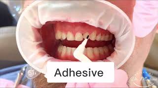 Smile Enhancement with Upper Porcelain Veneers