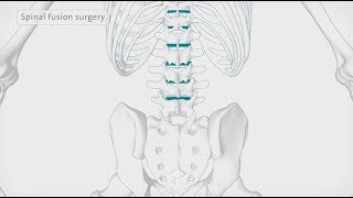 How back surgery (spinal fusion) is performed | Spire Healthcare