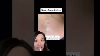 How do you avoid getting these blackheads and whiteheads? 👀