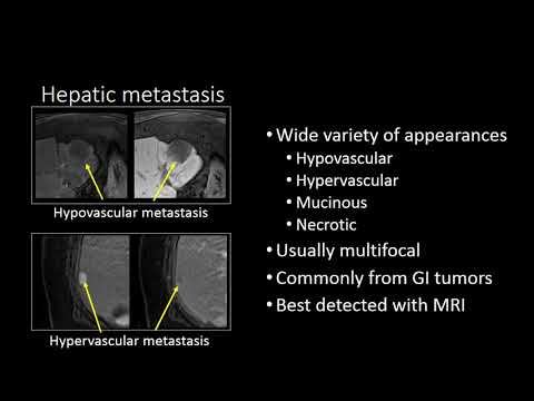 GI Imaging - Hepatic Metastasis