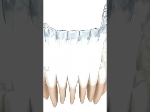 Animated Invisible Aligner Procedure