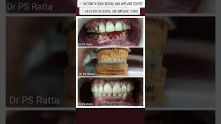 #smilecorrection #dentalclinic #fullmouthrehabilitation #smile