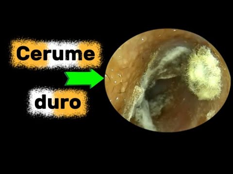 Pulizia delle Orecchie con Cera Dura Definitiva:Risultati Ineguagliabili e Soddisfazione Profonda