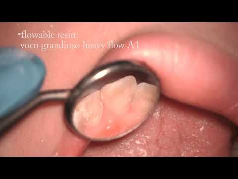 Anterior Ceramic Crown Preparation Using Extaro 300 Microscope