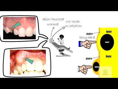 Adenomatoid odontogenic tumor
