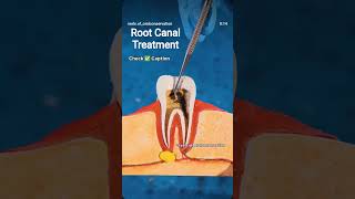 #awezchaitrend# Root canal treatment # save tooth in RCT #dentist #