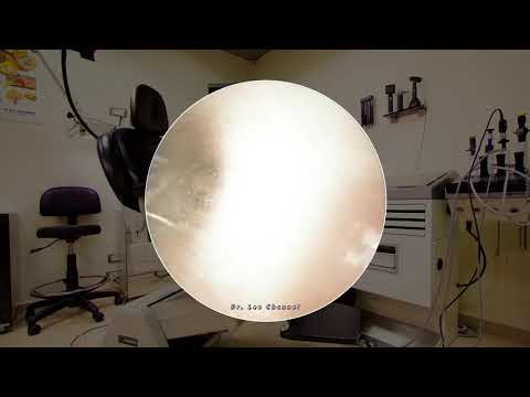 Remove GIANT EARWAX from a young girl’s ear
