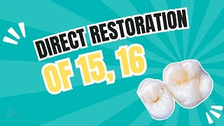 Direct restoration of 15, 16