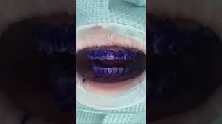 Teeth cleaning plaque test #dentalartistry
