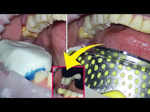 Tooth preparation for crowns, impression taking