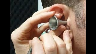 STOP Using Q Tips for Earwax Removal!