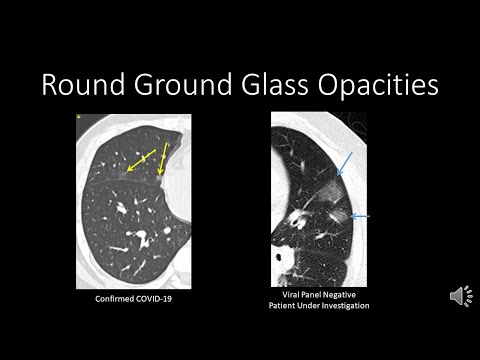 COVID-19: CT Findings