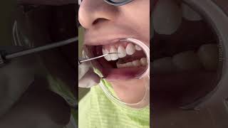 Seamless Veneers: Transform A Smile 🦷✨#shorts #aesthetic #aestheticdentistry #smile