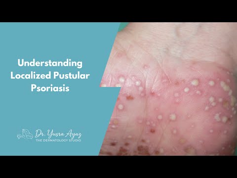 Lecture 7: Localized Pustular Psoriasis - Palmoplantar Pustulosis & Acrodermatitis of Hallopeau