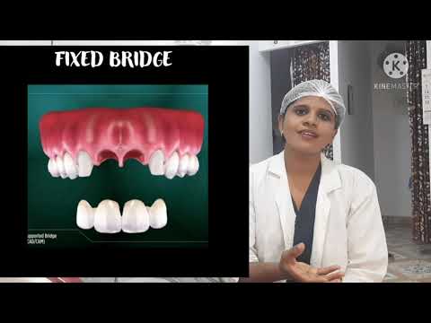 Missing teeth treatment options in tamil