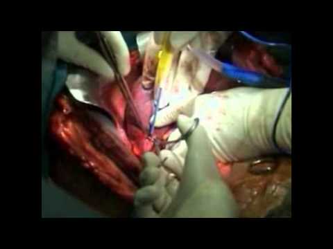 liver Transplant Centers in India