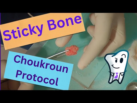 STICKY BONE by Choukroun Protocol