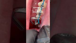 Trimming A Poking Braces Wire 🦷