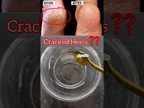 Cracked heels home remedy #youtubeshorts #recipe #remedies