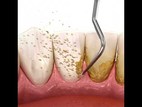 Scaling of teeth with ultrasonic scaler