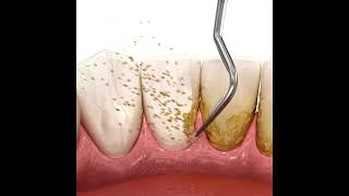 Scaling of teeth with ultrasonic scaler